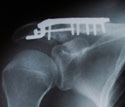 Click on the image to see the details oif this cool x-ray from Downhill Dave's shoulder :)